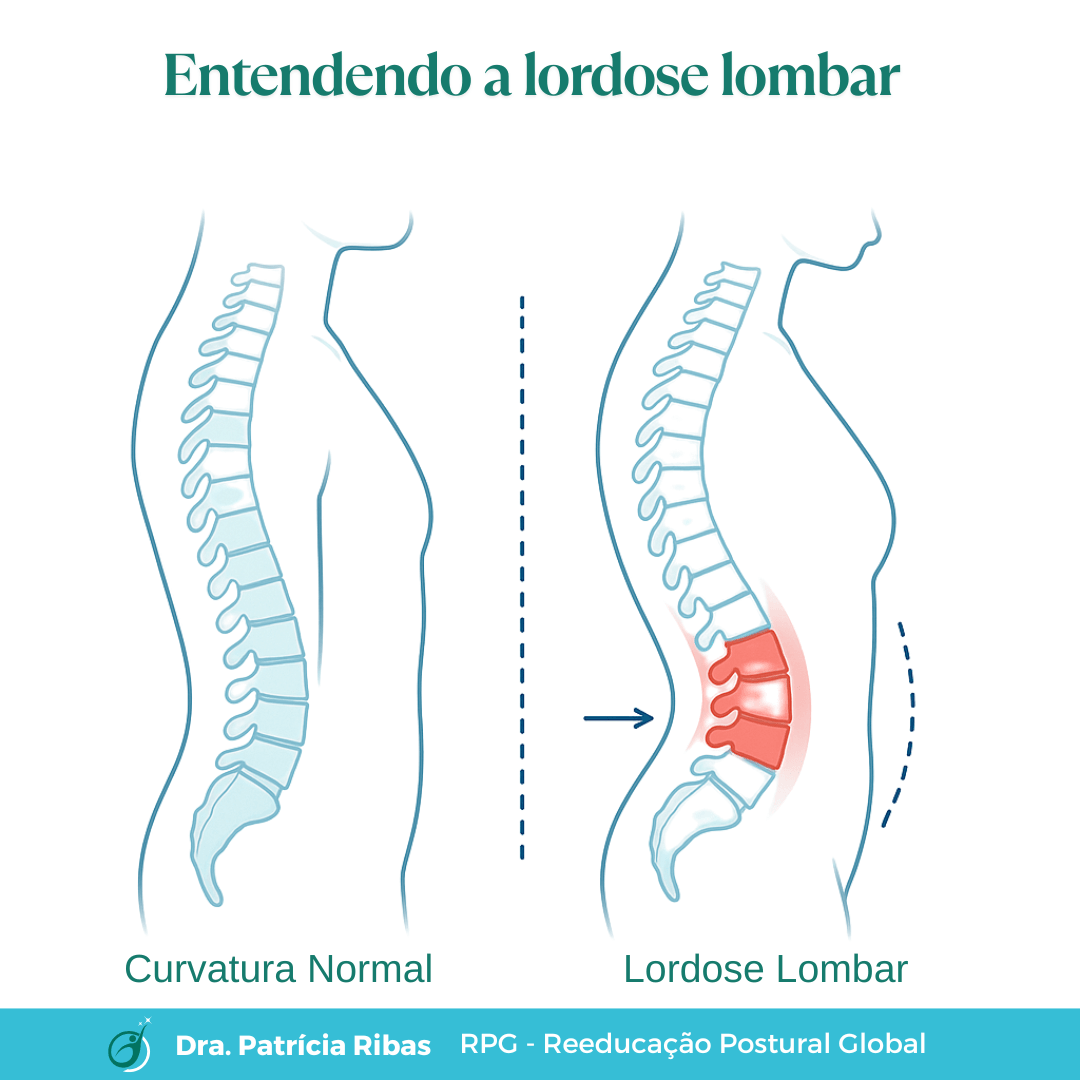 Representação visual simplificada de hiperlordose