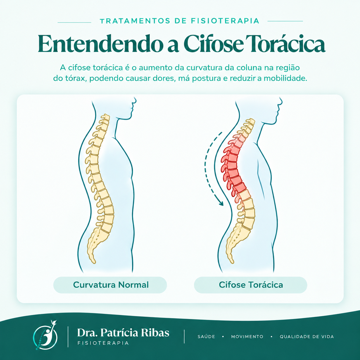 Ilustração de cifose torácica