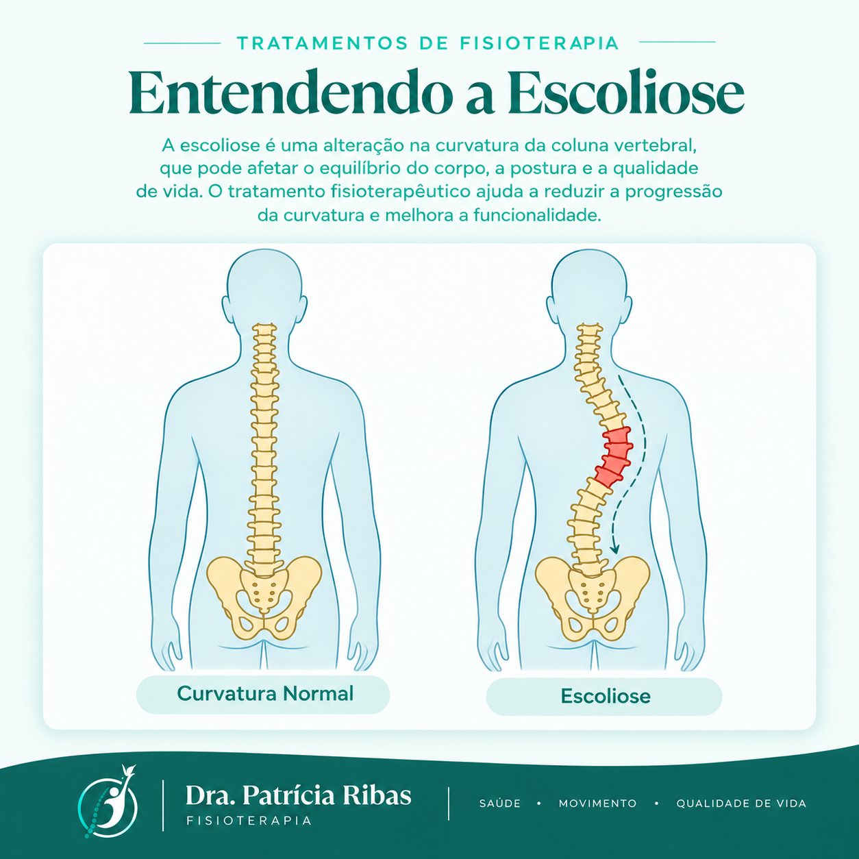 Ilustração de escoliose