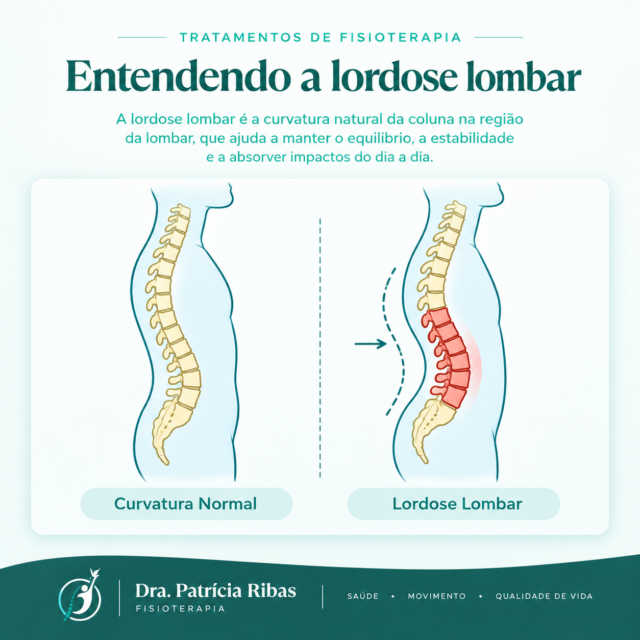 Ilustração de lordose lombar
